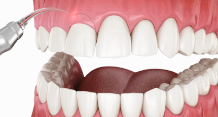 Advanced Gum Surgery in Kumbakonam