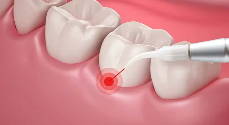 Advanced Gum Surgery in Kumbakonam