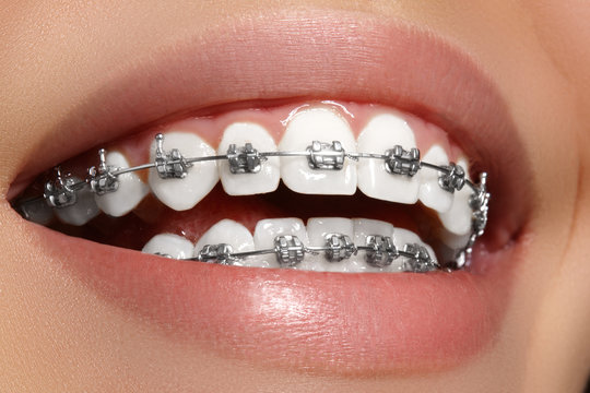 Braces or Aligners? Understanding Your Orthodontic Options