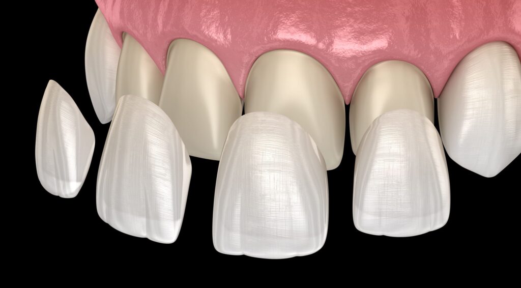Dental Veneers: Smile Makeovers in Kumbakonam