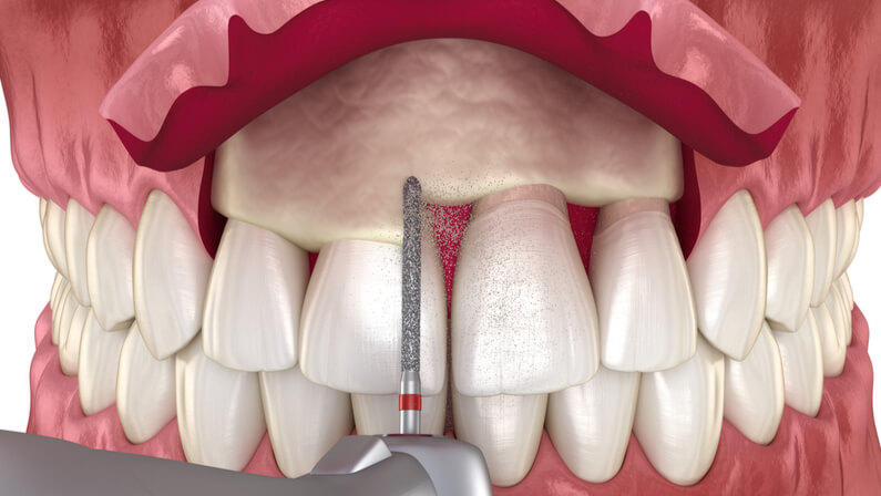 Gingivectomy with Osseous Contouring