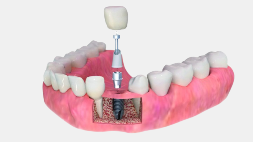 Who Can Get Dental Implants? Key Health Factors