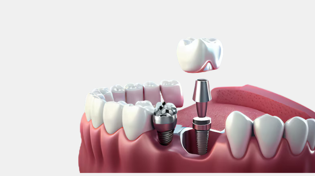 Who Can Get Dental Implants? Key Health Factors