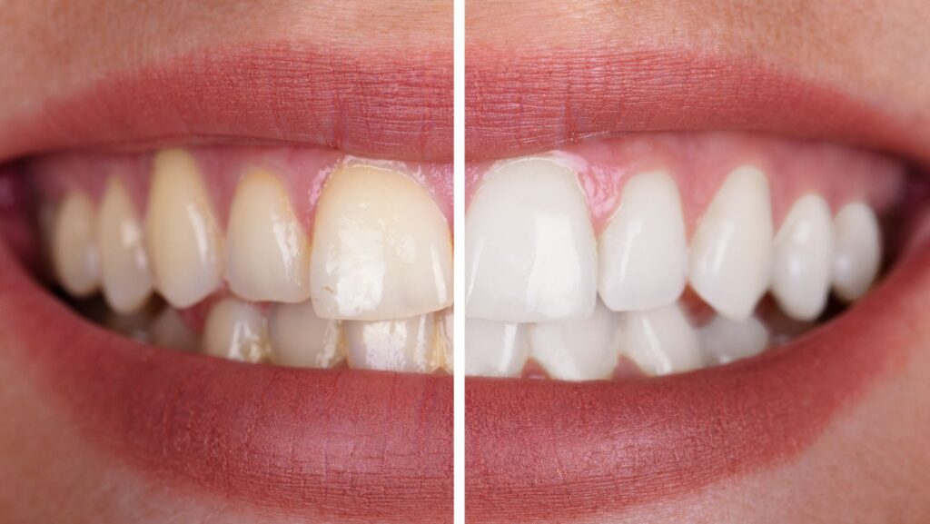 Why Regular Teeth Cleaning Is Essential for a Healthy Smile