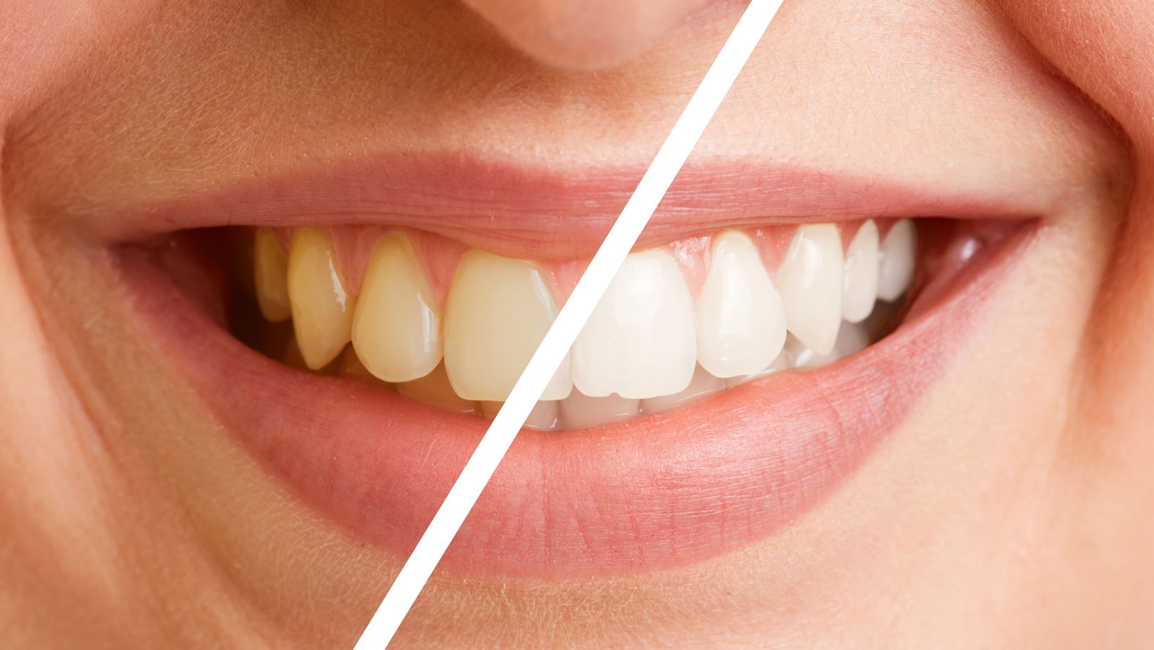 Why Regular Teeth Cleaning Is Essential for a Healthy Smile