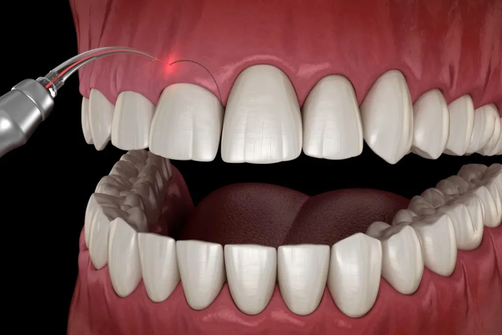 Gingivectomy with Osseous Contouring