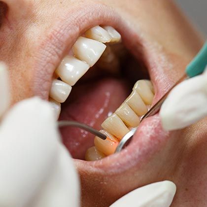 "Gum Contouring Side Effects & Recovery – Expert Care at Nalamm Dental Cosmetiks"