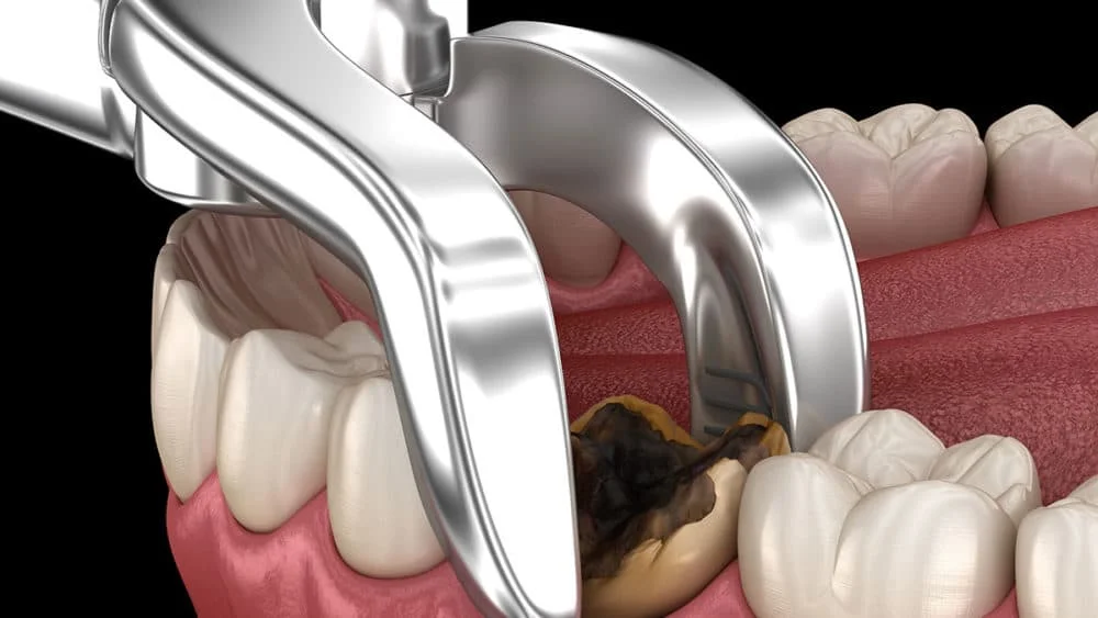 "Painless Wisdom Teeth Removal in Kumbakonam – Trust Nalamm Dental Cosmetiks for Expert Care"