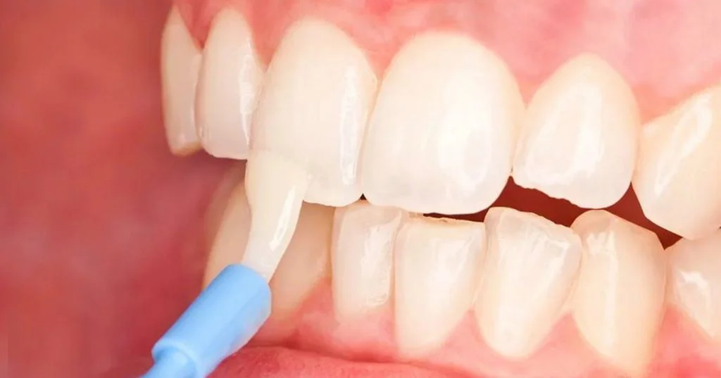 Dental Fluoride Treatment – Nalamm Dental Cosmetiks in Kumbakonam: Your Shield Against Tooth Decay