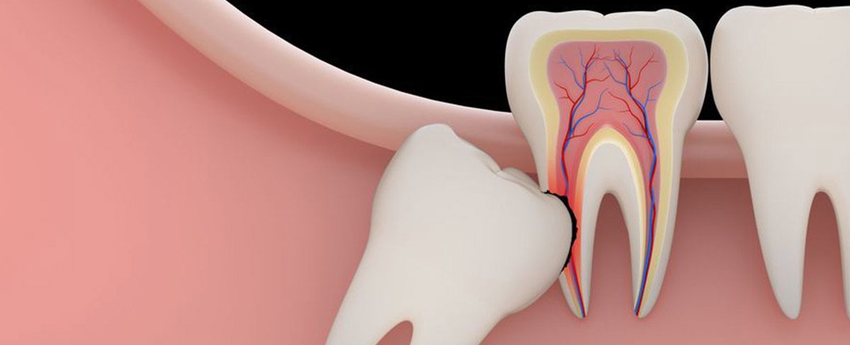 Wisdom tooth pain? Choose Nalamm Dental Cosmetiks in Kumbakonam for gentle, expert removal and a smooth recovery.