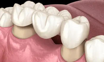 "Restore Your Smile with Confidence: Moral Crowns at Nalamm Dental Cosmetiks, Kumbakonam"