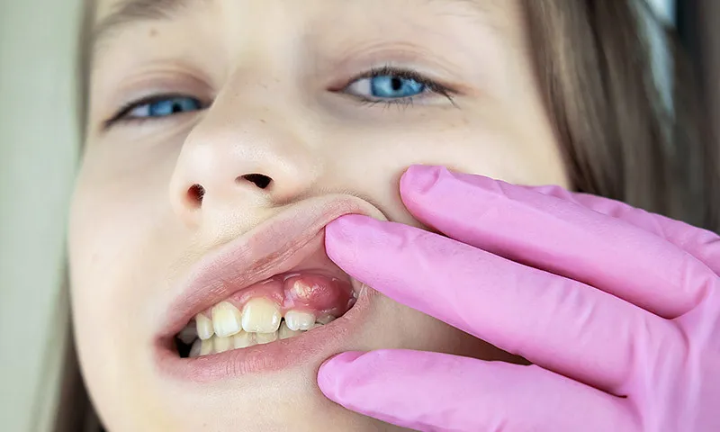 “Relieve Pain Fast: Abscess Drainage Treatments – Nalamm Dental Cosmetiks in Kumbakonam”