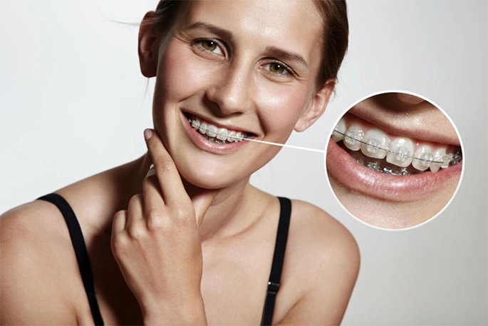 Invisible Confidence: Your Guide to Ceramic Braces in Nalamm Dental Cosmetiks in Kumbakonam