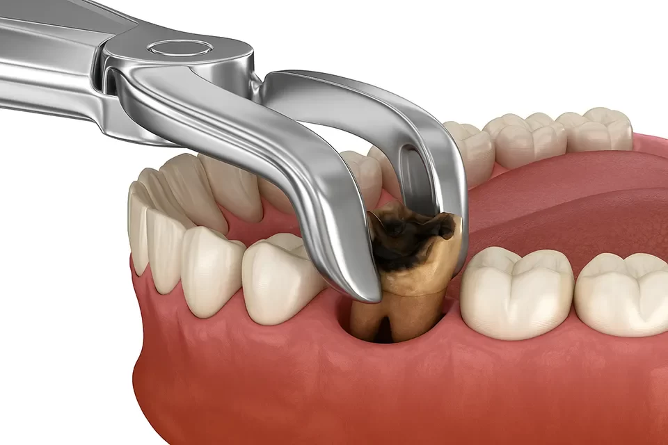 "Pain-Free Tooth Extraction – Trusted Care at Nalamm Dental Cosmetiks in Kumbakonam"