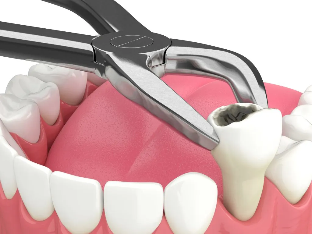 "Pain-Free Tooth Extraction – Trusted Care at Nalamm Dental Cosmetiks in Kumbakonam"