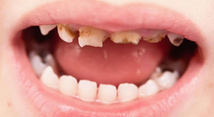 “Protect Tiny Smiles: Pulp Therapy for Milk Teeth – Nalamm Dental Cosmetiks in Kumbakonam”