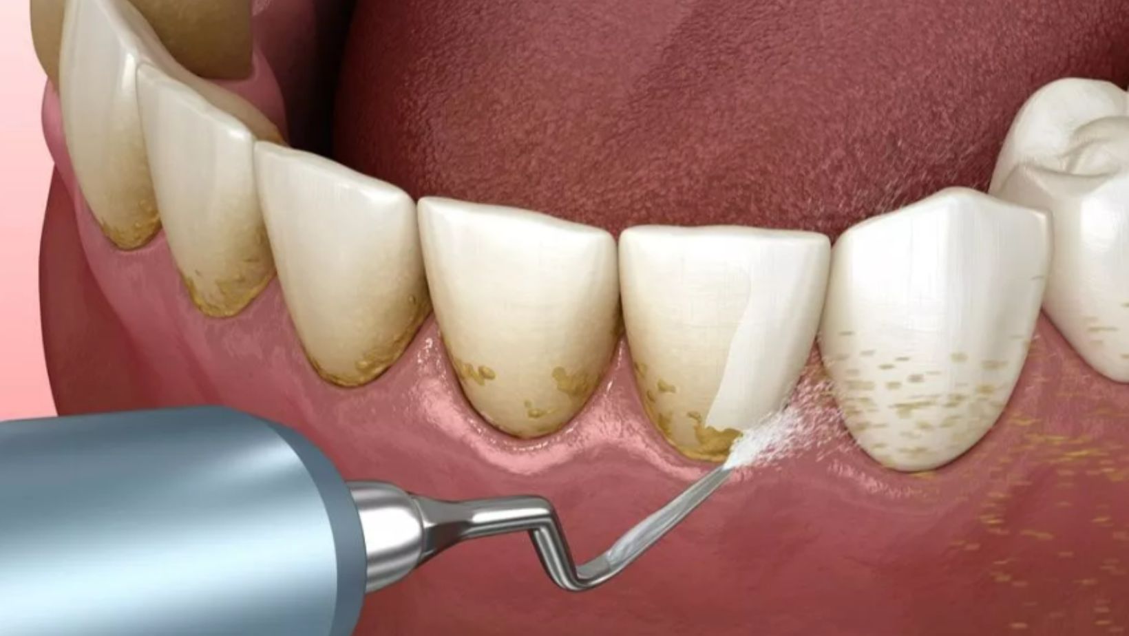 Say Goodbye to Gum Problems with Deep Teeth Cleaning – Nalamm Dental Cosmetiks, Kumbakonam