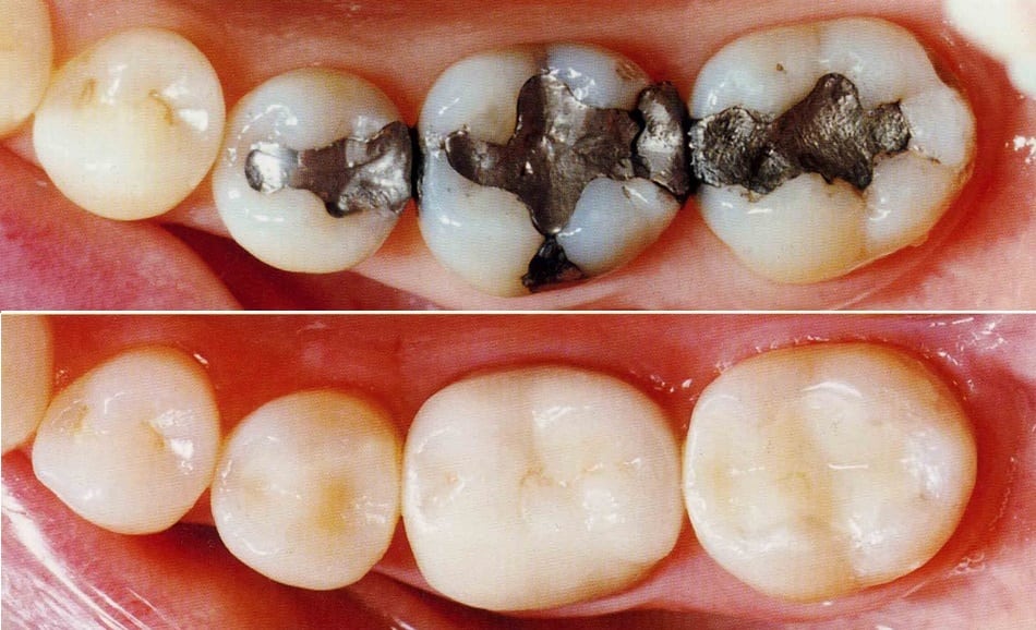 “Seamless Smiles Start Here – Tooth-Colored Fillings by Nalamm Dental Cosmetiks in Kumbakonam”