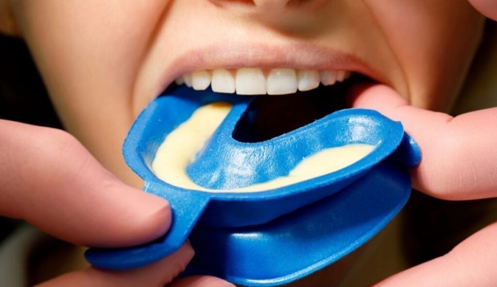 The Shield Against Decay: Fluoride & Sealant Treatments @ Nalamm Dental Cosmetiks in Kumbakonam