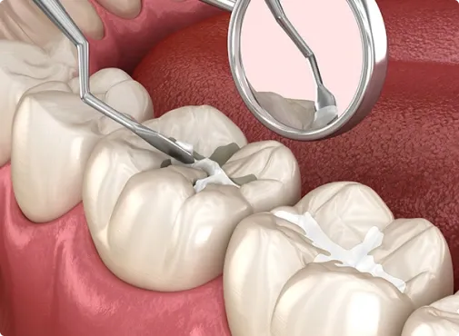 The Shield Against Decay: Fluoride & Sealant Treatments @ Nalamm Dental Cosmetiks in Kumbakonam