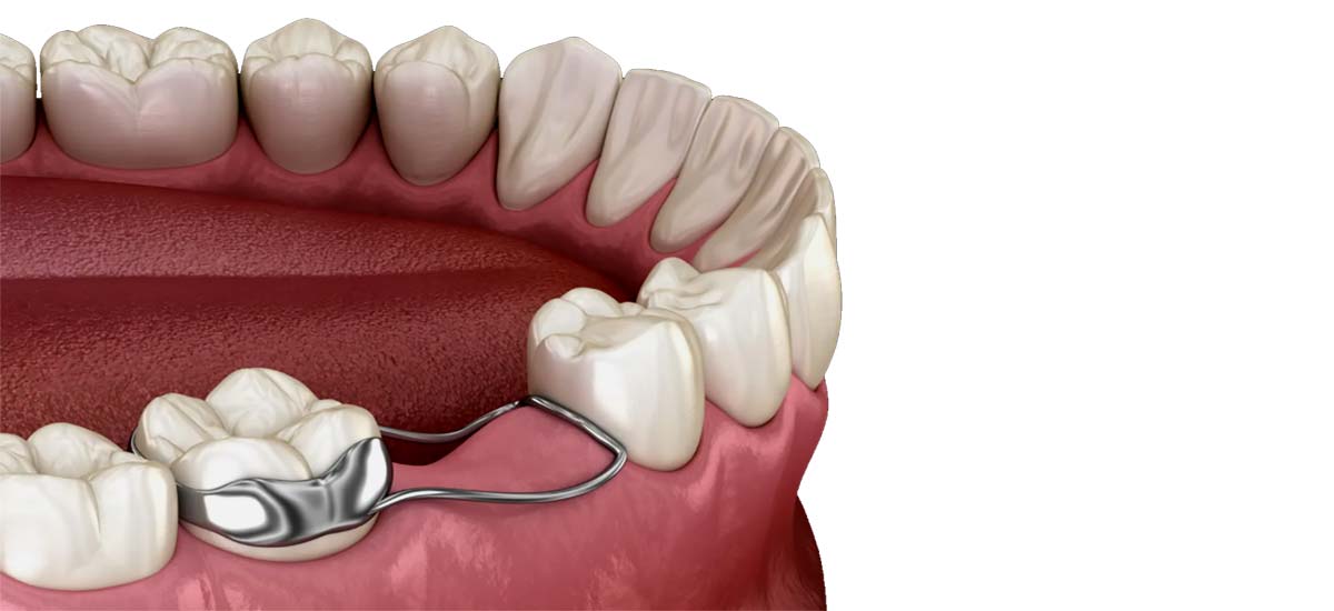 "Perfect Smiles from the Start: Early Orthodontic & Space Maintainer Care – Nalamm Dental Cosmetiks"