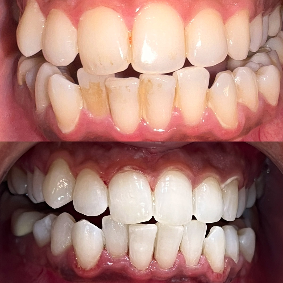 Brighten your smile with expert teeth whitening at Nalamm Dental Cosmetiks, Kumbakonam! Get instant, safe, and lasting results. Book now for your confident smile! 💎 #TeethWhitening #NalammDental