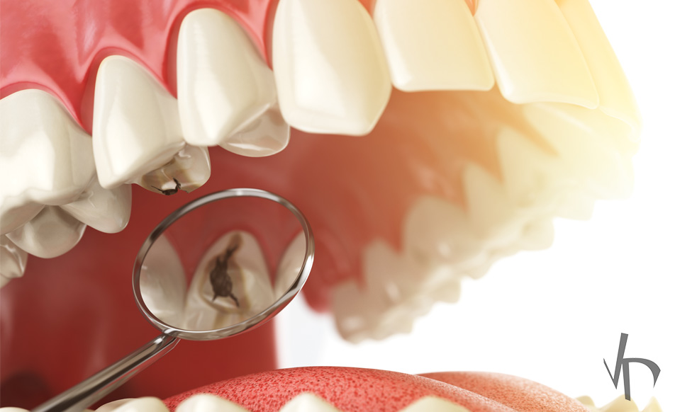 Healthy Smiles Start with Prevention – Caries Preventive Treatment – Nalamm Dental Cosmetiks in Kumbakonam