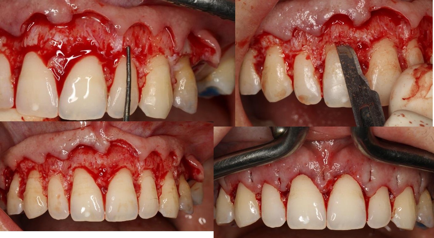 Periodontal Plastic Surgery – Nalamm Dental Cosmetiks in Kumbakonam | Aesthetic Gum Correction Experts