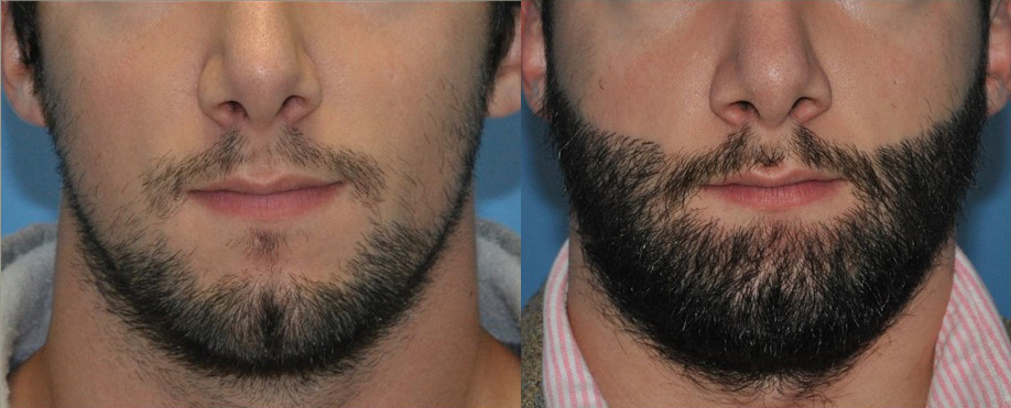Beard Transplant & Facial Hair Restoration in Kumbakonam | Nalamm Dental Cosmetiks