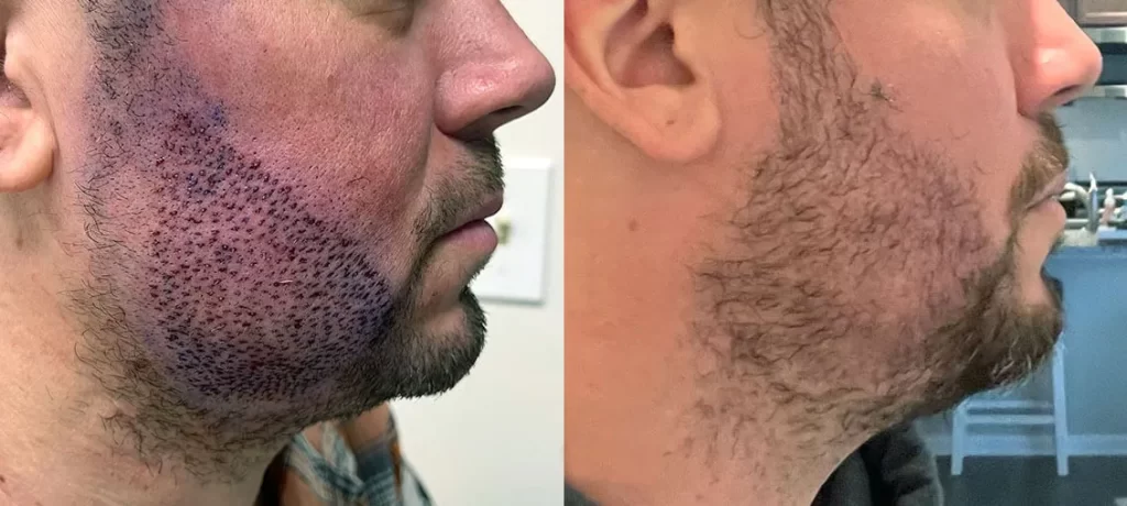 Your beard defines your confidence.
Let us help you grow it naturally with advanced beard transplant treatment at Nalamm Dental Cosmetiks 💯