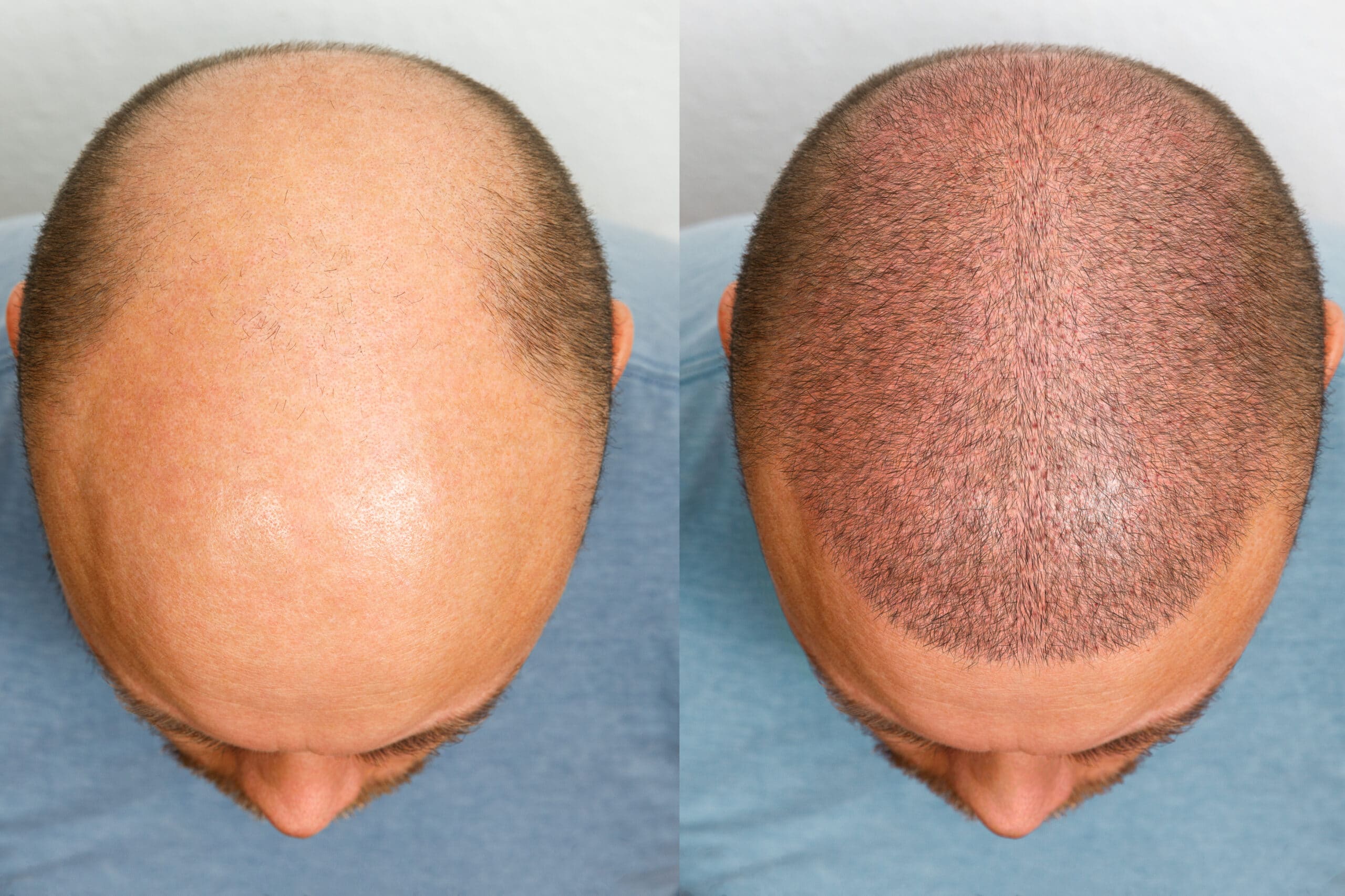 Hair Transplant Surgery in Kumbakonam | Nalamm Dental Cosmetiks