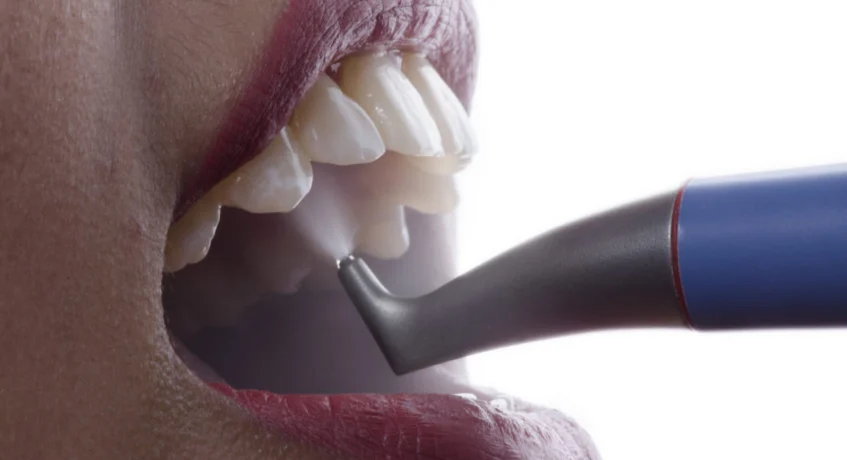 Advanced Airpolishing Treatments in Kumbakonam – Nalamm Dental Cosmetiks