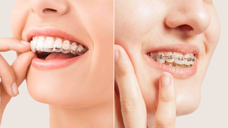 Braces & Aligners Treatments in Kumbakonam – Nalamm Dental Cosmetiks 2
