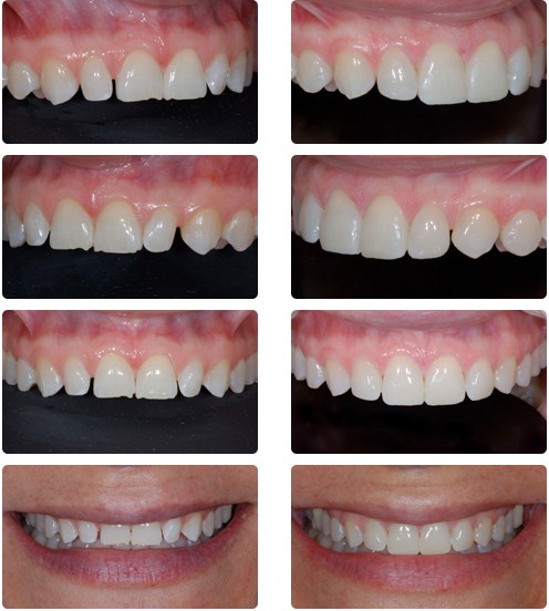 Composite Veneers Treatments in Kumbakonam – Nalamm Dental Cosmetiks