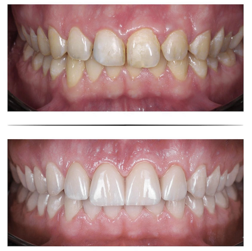 Composite Veneers Treatments in Kumbakonam – Nalamm Dental Cosmetiks