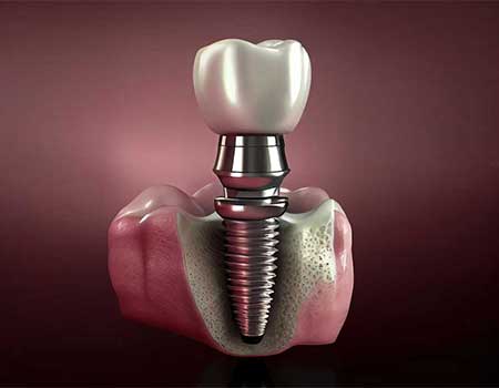 Dental Implant Clinic in Kumbakonam – Nalamm Dental Cosmetiks