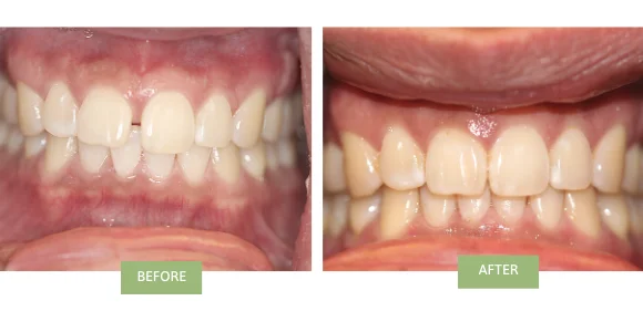 Best Mild Gap Closure Dental Treatment in Kumbakonam | Nalamm Dental Cosmetiks