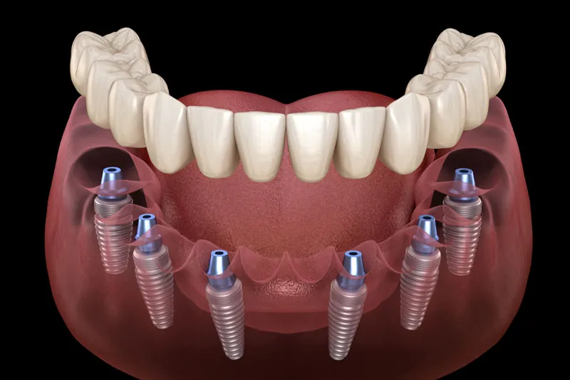 Price of Full Mouth Dental Implants in Kumbakonam | Nalamm Dental Cosmetiks