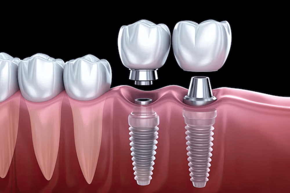 Teeth Transplant Cost in Kumbakonam – Nalamm Dental Cosmetiks