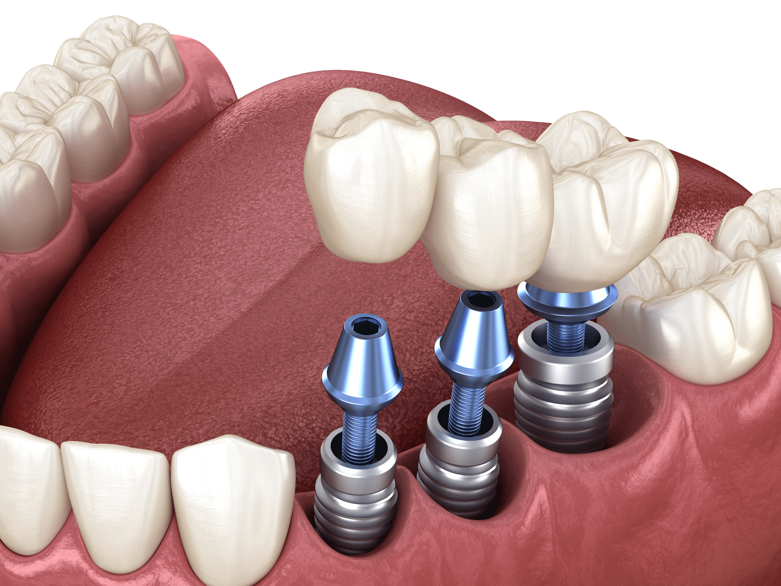 Teeth Transplant Cost in Kumbakonam – Nalamm Dental Cosmetiks