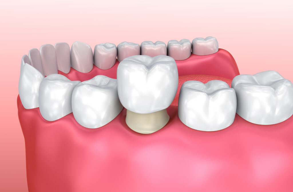 Dental Caps Treatments – Nalamm Dental Cosmetiks in Kumbakonam | Zirconia & Ceramic Crowns