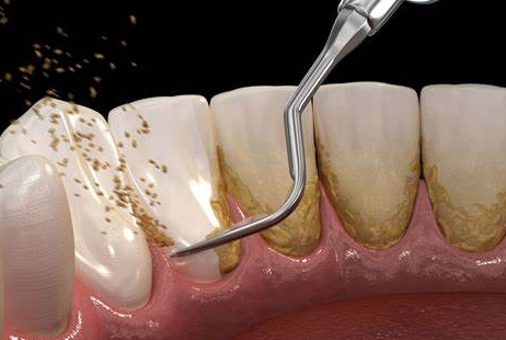 Best Scaling & Polishing of Teeth in Kumbakonam – Nalamm Dental Cosmetiks | Deep Cleaning Experts