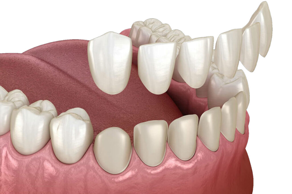 Cheap Veneers Treatments – Nalamm Dental Cosmetiks in Kumbakonam | Affordable Smile Makeover