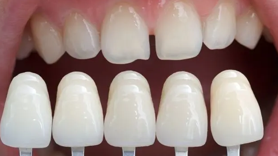 Cheap Veneers Treatments – Nalamm Dental Cosmetiks in Kumbakonam | Affordable Smile Makeover