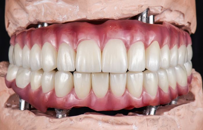 Full Arch Dental Implants Treatments – Nalamm Dental Cosmetiks in Kumbakonam | Permanent Teeth Solution