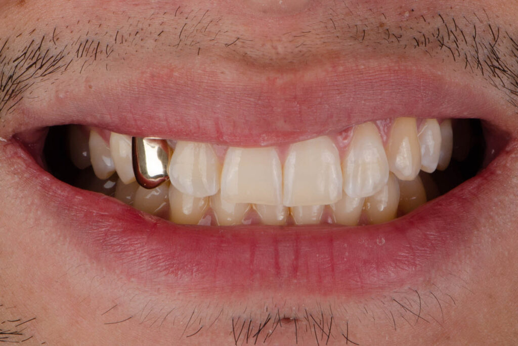 Gold Crown Tooth Treatments – Nalamm Dental Cosmetiks in Kumbakonam