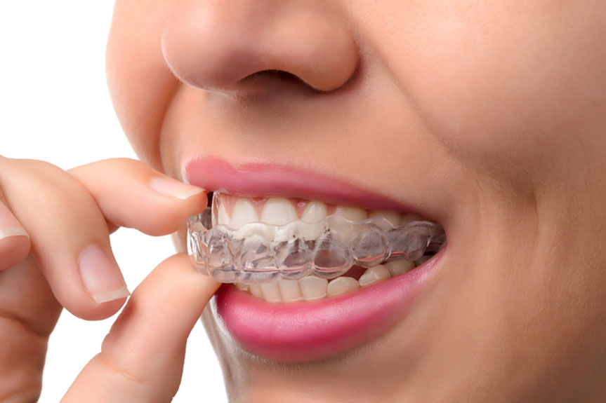 Invisalign Aligners Treatments – Nalamm Dental Cosmetiks in Kumbakonam | Clear Braces