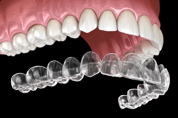 Invisalign Aligners Treatments – Nalamm Dental Cosmetiks in Kumbakonam | Clear Braces