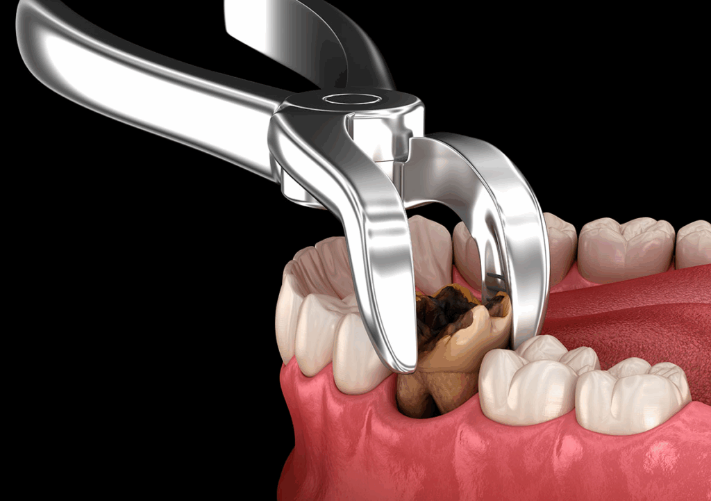 Molar Extraction Treatments – Nalamm Dental Cosmetiks in Kumbakonam | Safe Tooth Removal