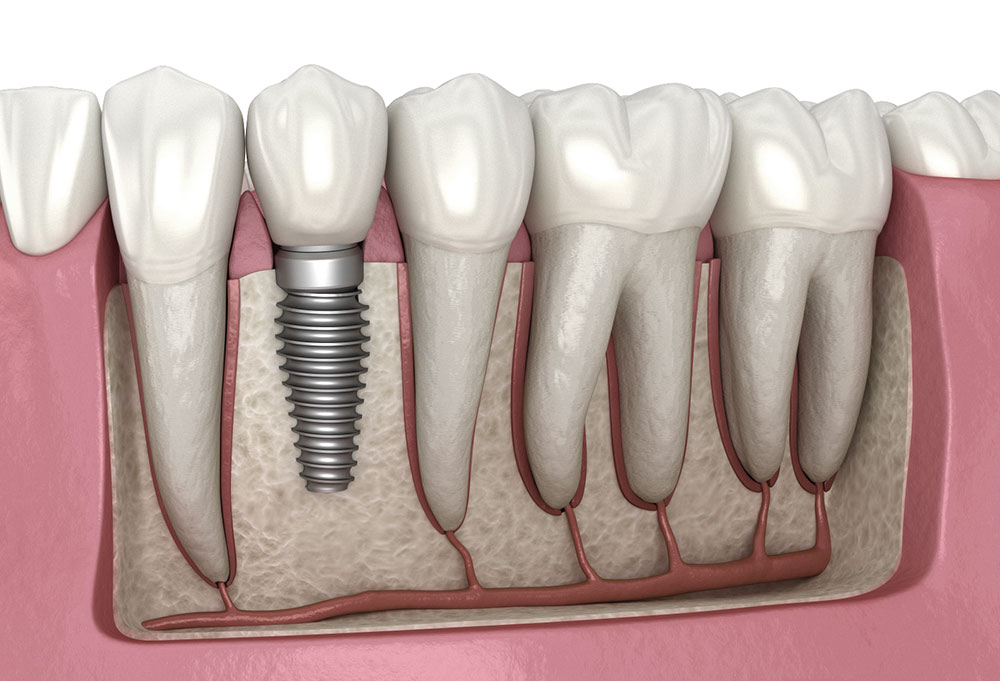Affordable Dental Implants Near Me in Kumbakonam – Nalamm Dental Cosmetiks